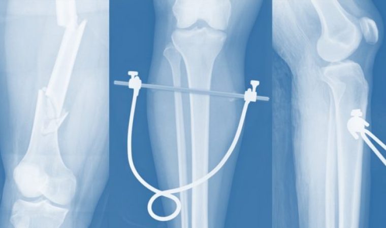 Special Sites of Skeletal Traction in Lower Limb